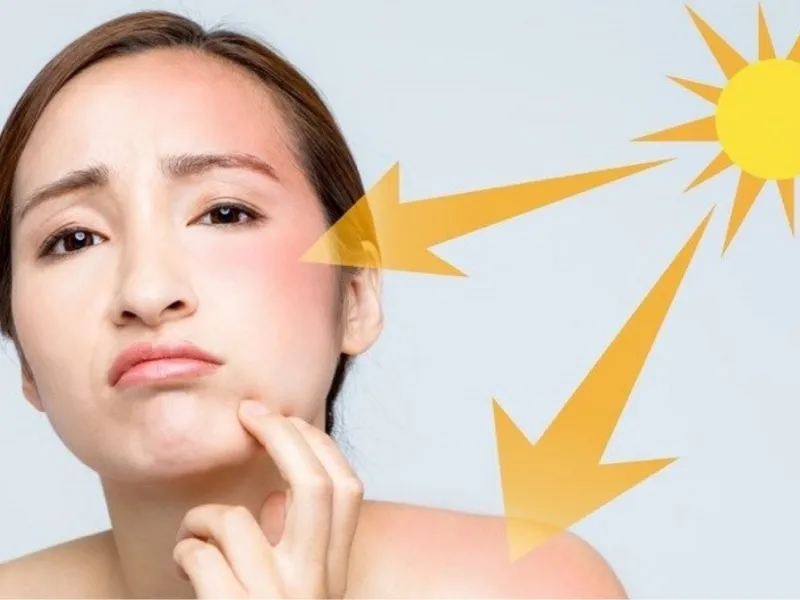 Da bị cháy nắng do nhiều yếu tố khác nhau không phải do nước dừa