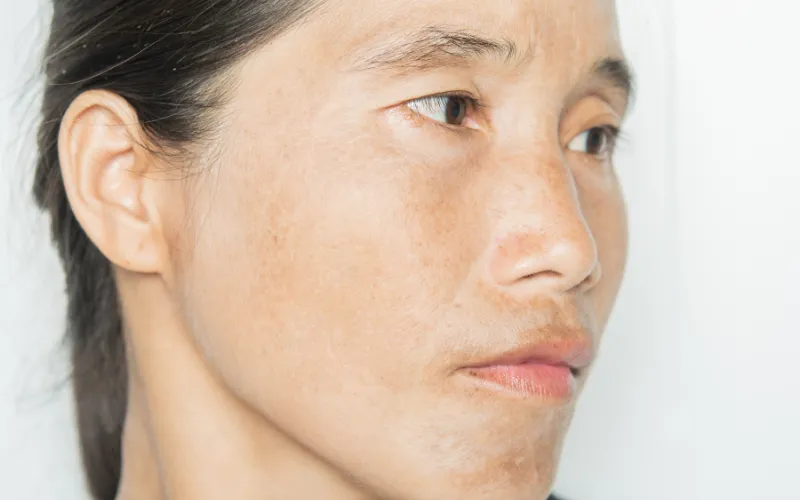 Giải mã: Thức khuya có bị sạm da không?