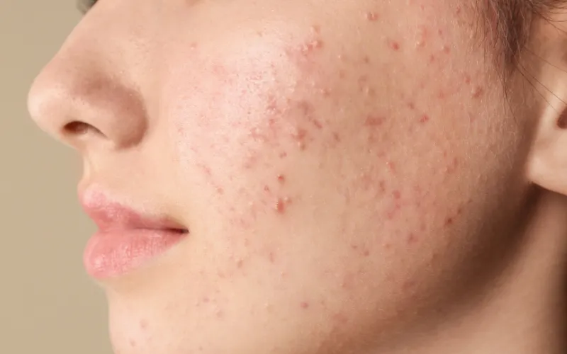 Các dấu hiệu nhận biết da bị ảnh hưởng do thức khuya