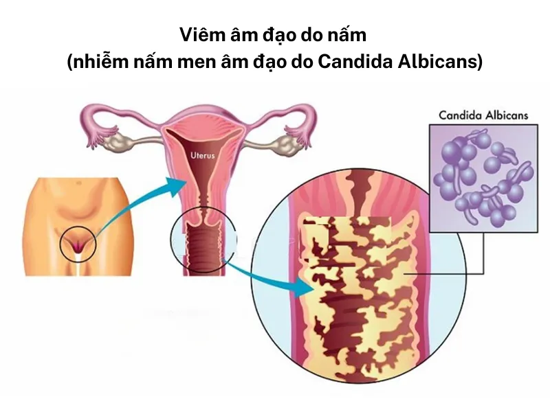 Viêm phụ khoa sau khi sinh là gì?