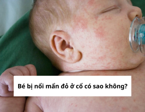 bé bị nổi mẩn đỏ ở cổ