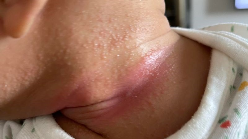 bé bị nổi mẩn đỏ ở cổ