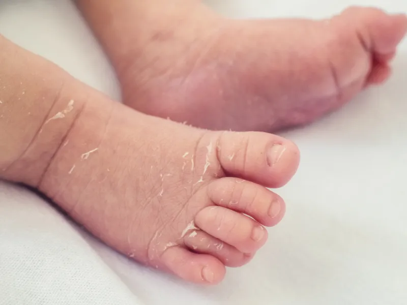 Vì sao trẻ sơ sinh cần kem dưỡng ẩm?