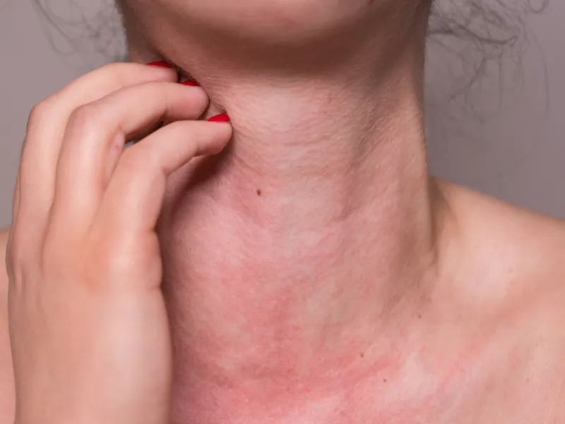 Dị ứng thời tiết tắm lá gì?