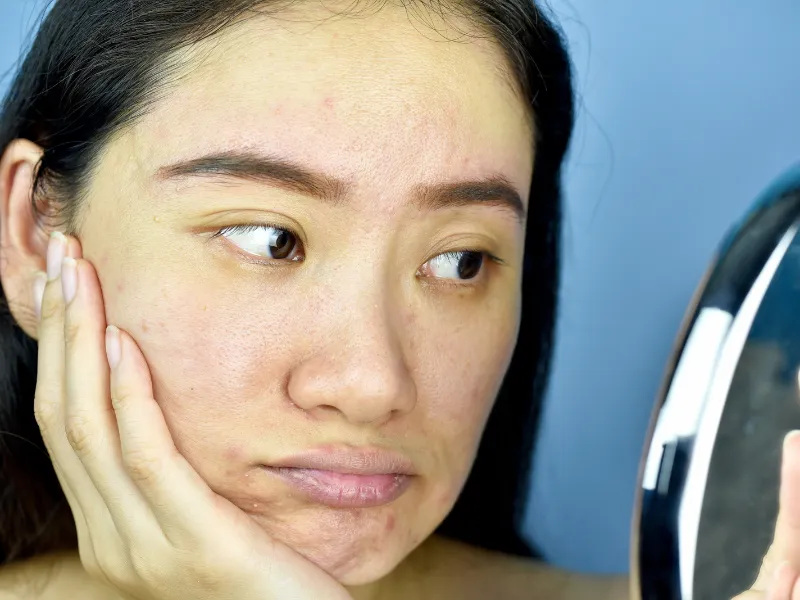 Dùng kem chống nắng có làm bít lỗ chân lông không?