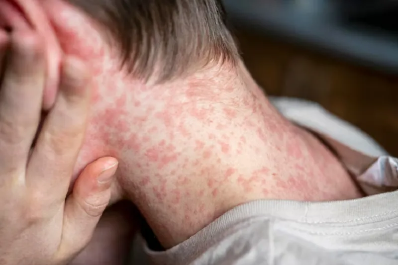 Phân biệt rôm sảy và sởi qua triệu chứng đi kèm