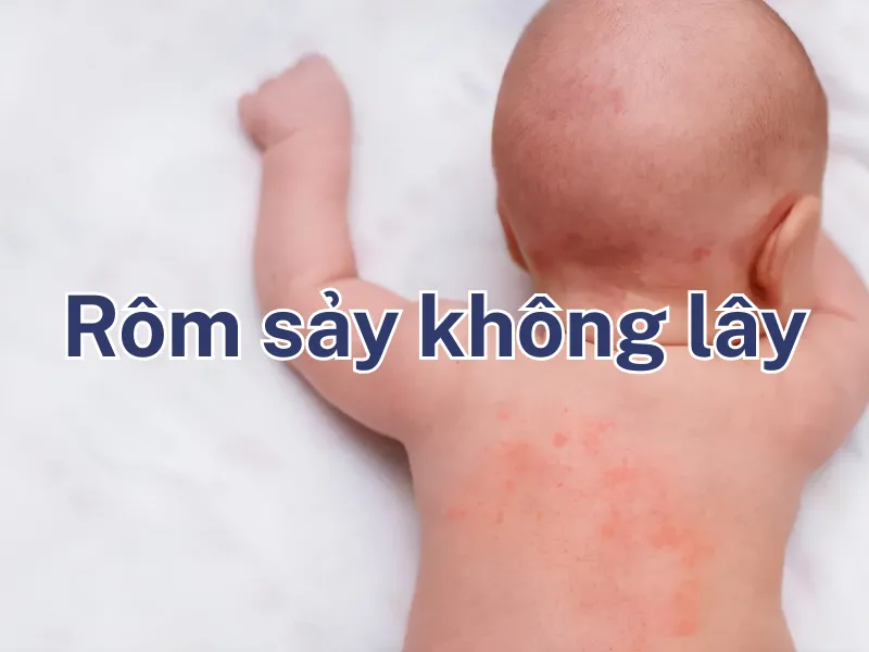 Rôm sảy có lây không?