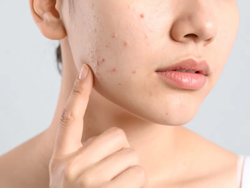 Hỗ trợ làm dịu da mụn