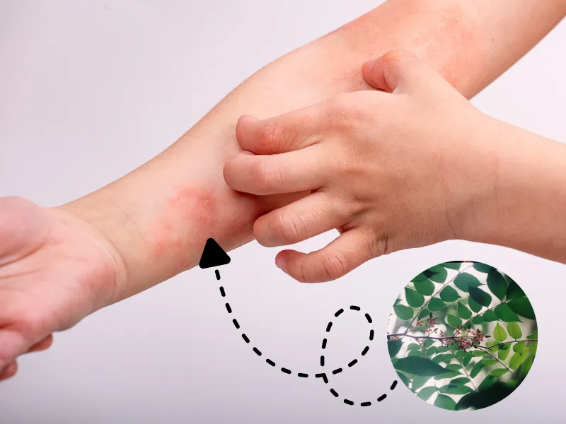 Hỗ trợ người bị viêm da cơ địa