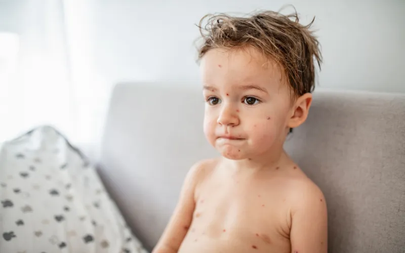Trẻ bị phỏng dạ tắm lá gì là phù hợp nhất?