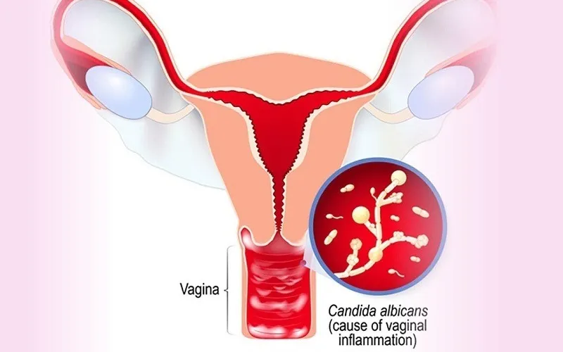 Nhiem-nam-Candida