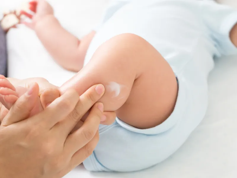 Bé bị viêm da cơ địa có thể bôi corticosteroid không?
