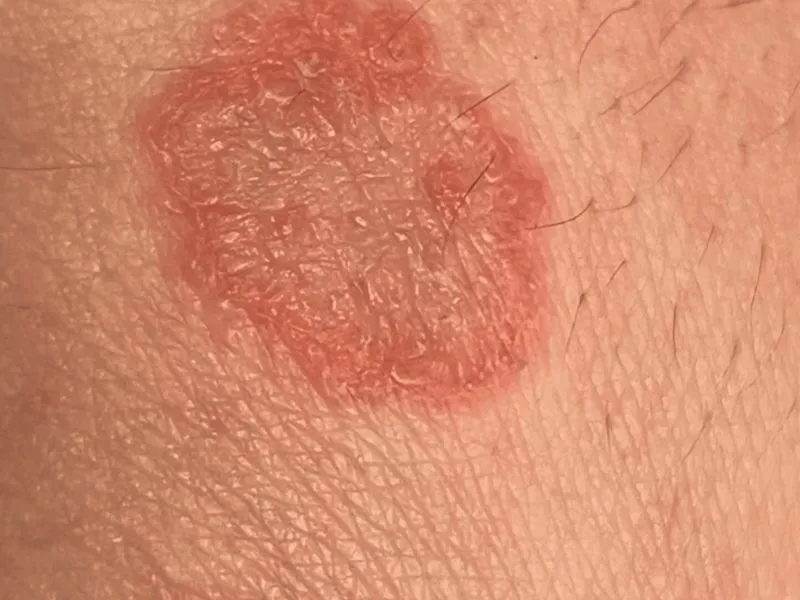 Chàm đồng tiền (Nummular eczema)