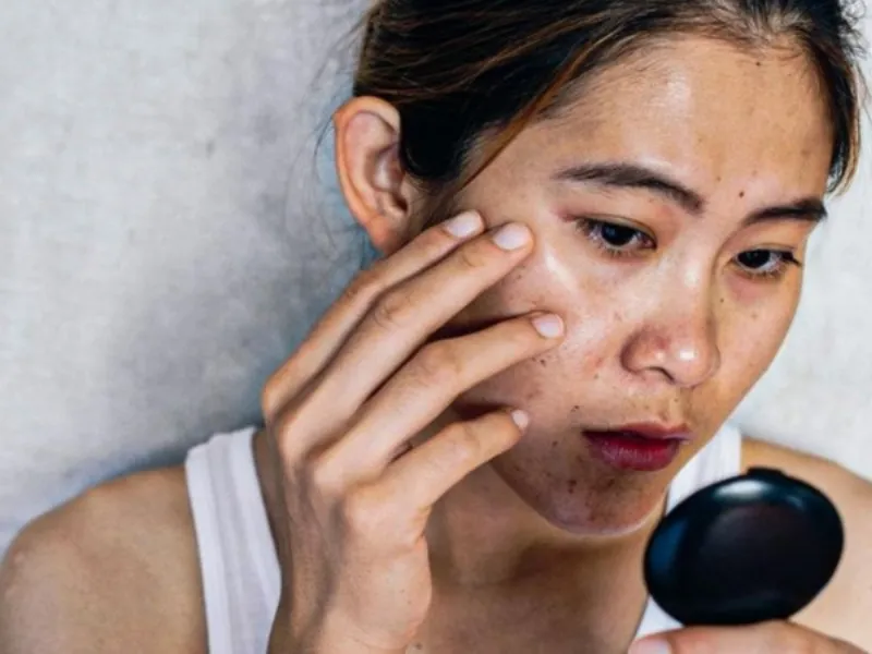 Sự thay đổi nội tiết tố là yếu tố chính khiến da mặt mẹ sau sinh bị ảnh hưởng