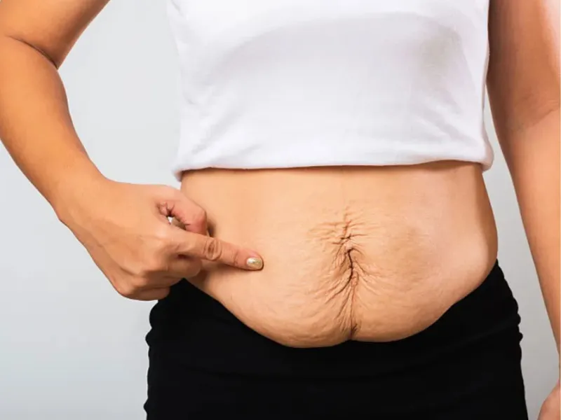 Da bụng mẹ thường gặp tình trạng chùng nhão, kém săn chắc