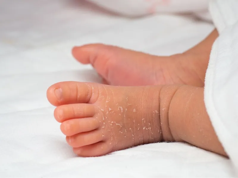 Da cáy là tình trạng thường gặp ở trẻ sơ sinh