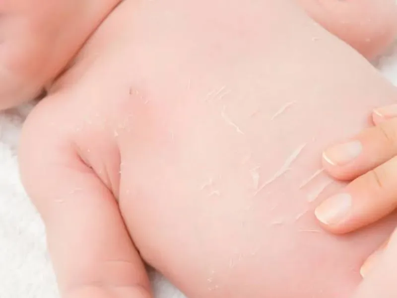 Dấu hiệu thường gặp là trẻ bị khô, hơi căng và bong tróc thành từng mảng nhỏ.