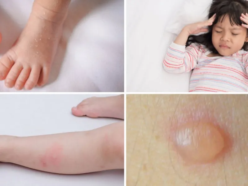 Các triệu chứng thường xuất hiện sau vài giờ kể từ khi trẻ tiếp xúc với ánh nắng