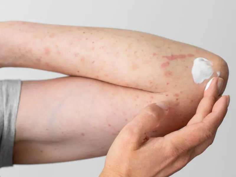 Kem bôi có chiết xuất rau má nên được lựa chọn kỹ càng