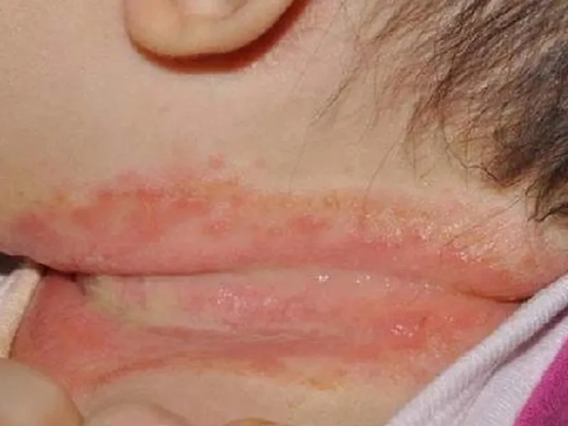 Hăm da có thể xuất hiện ở cả vùng cổ của trẻ