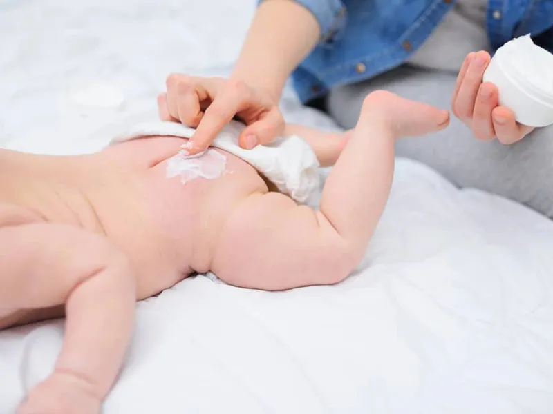 Ngoài tắm lá, ba mẹ nên kết hợp bôi kem chống hăm