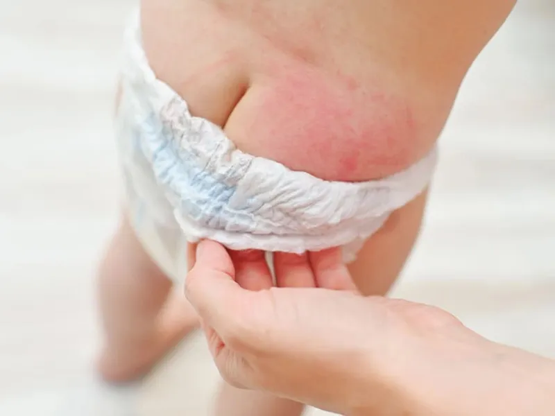 Hăm da là tình trạng viêm da kích ứng phổ biến ở trẻ sơ sinh và trẻ nhỏ