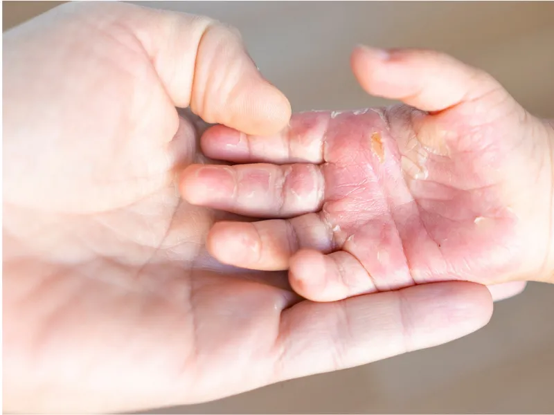 Di truyền được xem là một trong những yếu tố nguy cơ quan trọng của viêm da cơ địa
