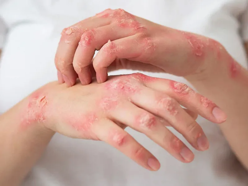Viêm da cơ địa bàn tay