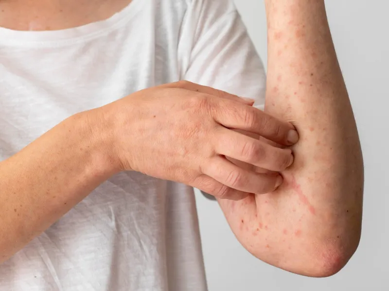 Giải đáp viêm da cơ địa có hết không?
