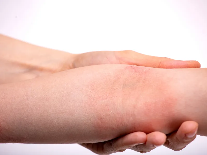 Viêm da cơ địa là gì?