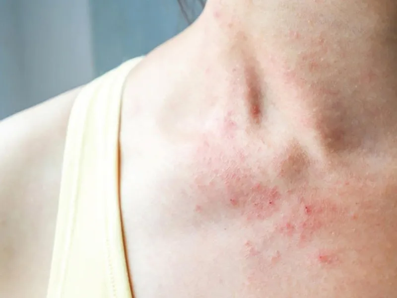 Viêm da cơ địa mùa hè là gì?