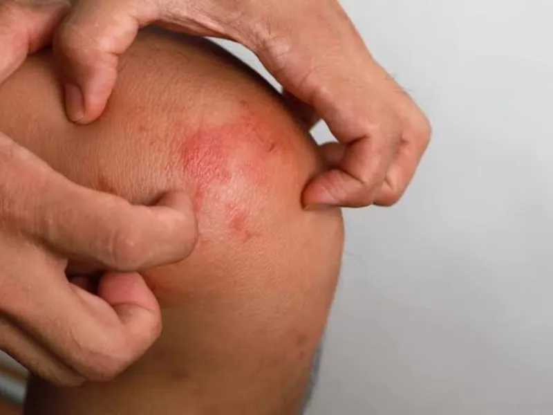 Viêm da cơ địa ở chân gầy ảnh hưởng đến sinh hoạt hằng ngày