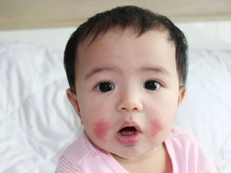 Dấu hiệu viêm da cơ địa ở em bé cha mẹ cần nhận biết