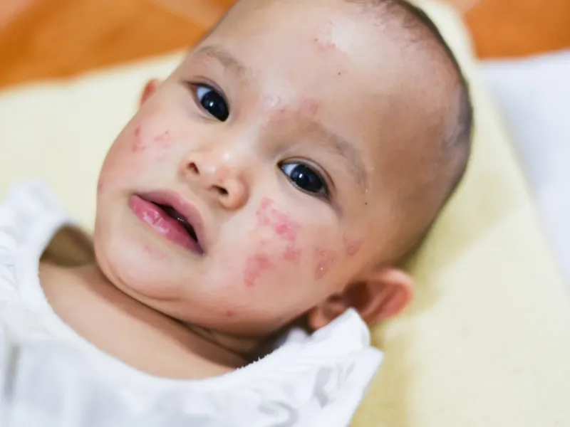Viêm da cơ địa ở em bé là gì?