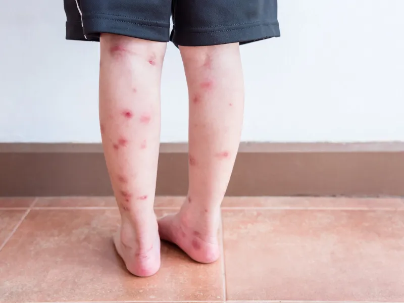 Bé bị bọ chét cắn có sao không?