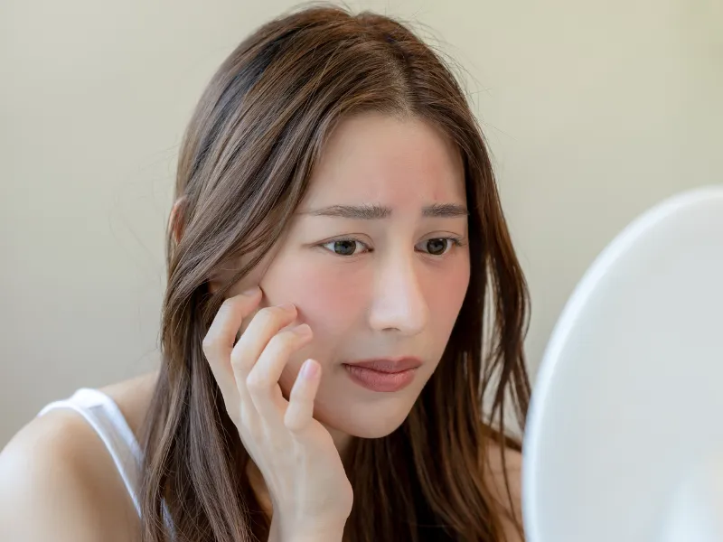 Dấu hiệu da có thể gặp sau khi sử dụng corticoid không phù hợp