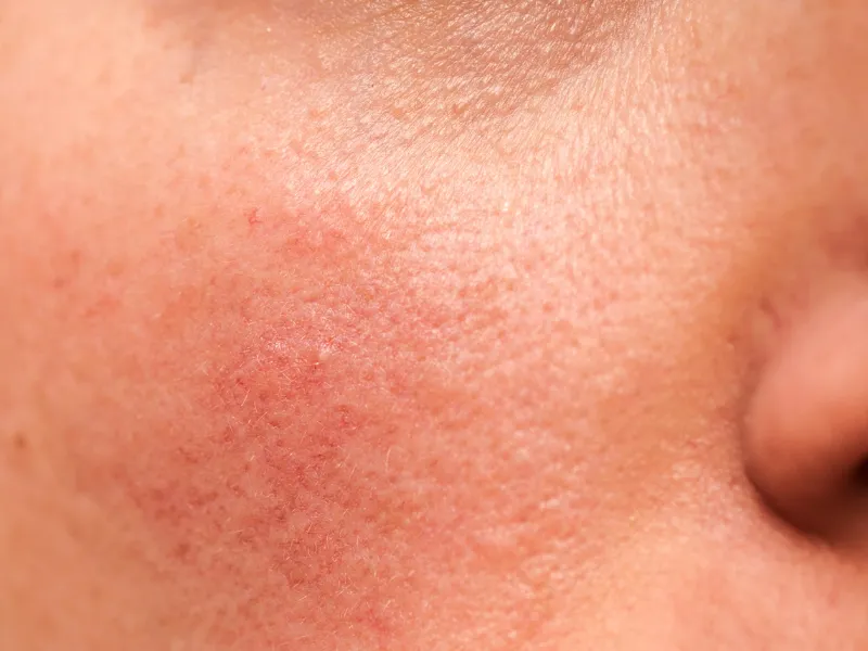 Da nhiễm corticoid là gì?