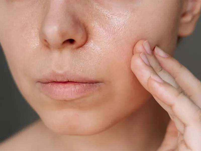 Da khô vẫn có thể tiết dầu, thậm chí rất nhiều dầu
