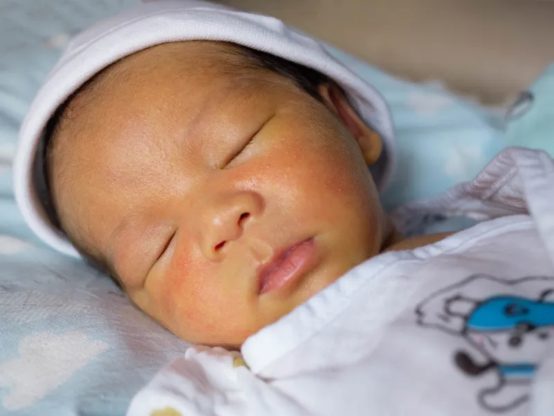 Vì sao trẻ sơ sinh bị vàng da?