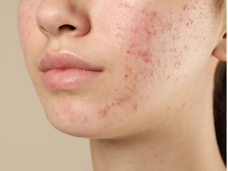 Mụn nội tiết khi mang thai là tình trạng da nổi mụn do sự thay đổi hormone trong cơ thể người phụ nữ trong thai kỳ