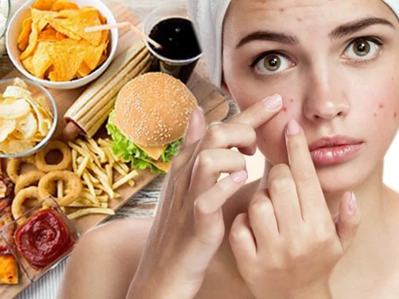 Mụn nội tiết cũng có thể là do chế độ ăn không lành mạnh