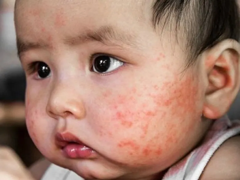 Chàm sữa là một dạng viêm da thường gặp ở trẻ dưới 2 tuổi