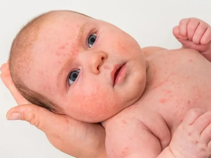 Chàm sữa thường bắt đầu bằng những vùng da đỏ ở hai bên má