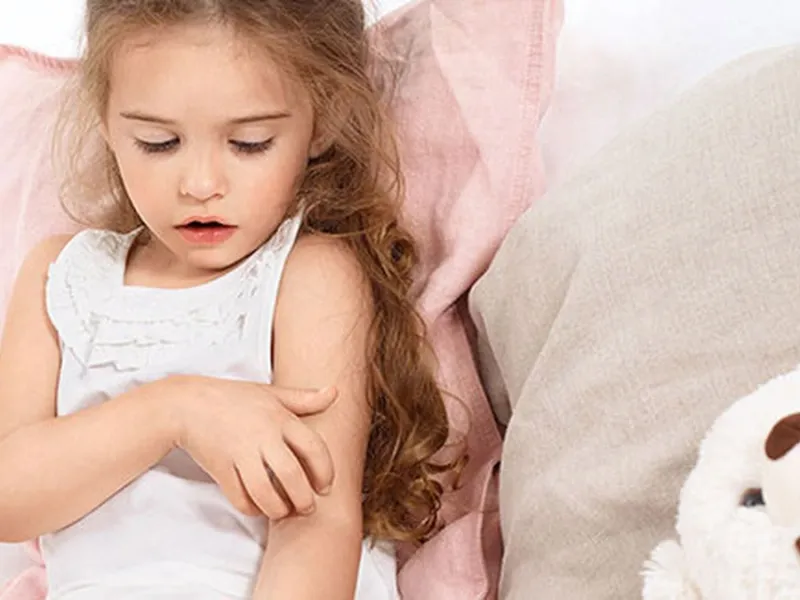 Chàm sữa thường không nguy hiểm nhưng có thể ảnh hưởng đến chất lượng