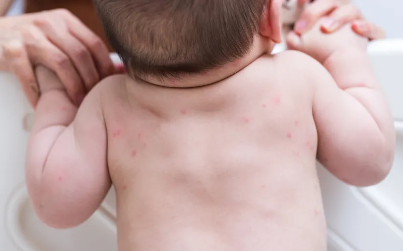 Không phải mọi trường hợp mẩn ngứa đều giống nhau