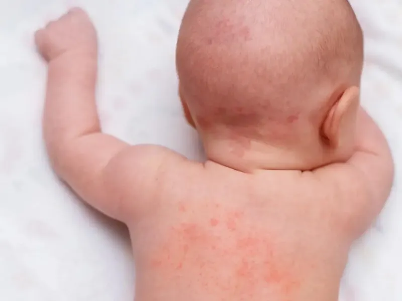 Lá rau sam có khả năng hỗ trợ giảm viêm và làm dịu da