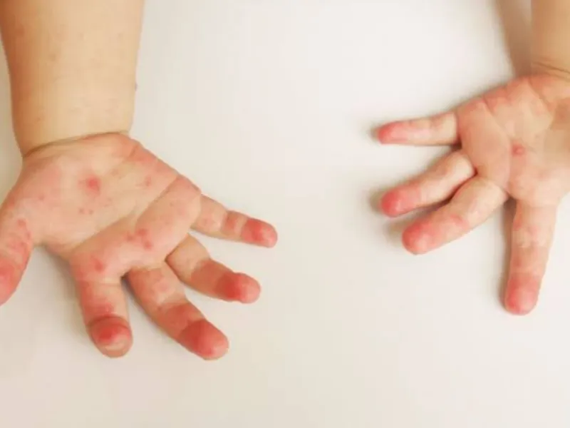 6 dấu hiệu bệnh chốc lở ngoài da ở trẻ em dễ nhận biết