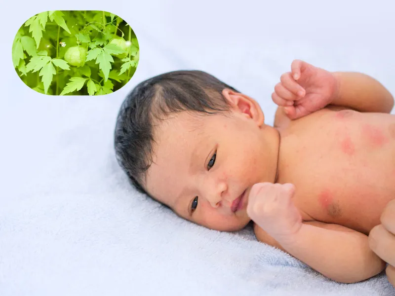 Cây tầm bóp có thể dùng tắm cho trẻ bị rôm sảy không?