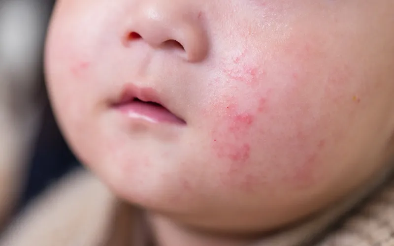 Bé đang bị chàm sữa hoặc viêm da cơ địa