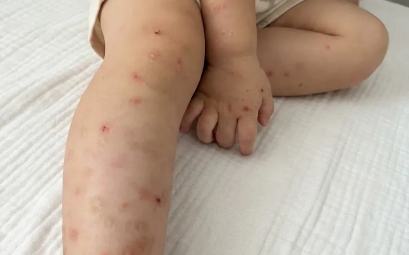 Tại sao vết muỗi đốt ở chân của trẻ lại lâu mờ và dễ để lại thâm sẹo?